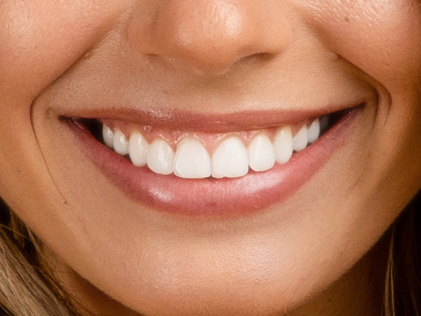 Using Teeth Whitening Using Teeth Whitening